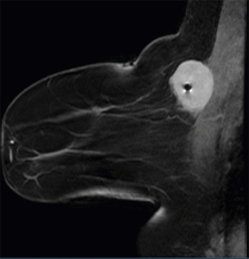 Image depicts right breast mass with intimal connection with pectoralis muscle, 3.0 × 3.5 × 4.5 cm, very dense lobulated mass with postbiopsy clip marker