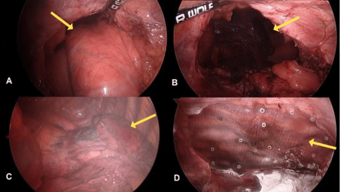 A) Herniating stomach through the diaphragmatic defect. B) Diaphragmatic defect after hernia reduction. C) Atelectatic left lung prior to re-expansion. D) Completed repair with relaxing incision, primary closure, and onlay absorbable mesh reinforcement.