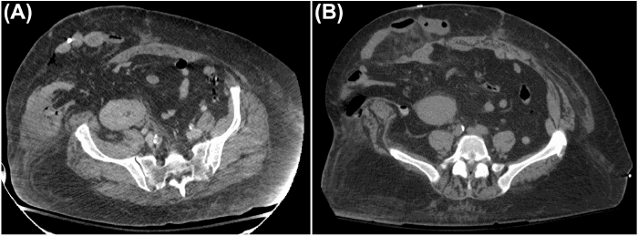 Axial CT images. (A) Scan obtained on POD 2 following kidney transplantation, demonstrating the initial fascial dehiscence with herniation of intra-abdominal contents. (B) Scan obtained on POD 7 following kidney transplantation (and after the first attempted mesh repair), showing recurrence of the fascial dehiscence with evidence of fascial edge retraction from the biologic mesh