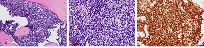 A and B): Hypercellular marrow (90%) with increased infiltration of atypical lymphocytes (predominantly small with scattered intermediate and large cells) is seen on H&E staining (40x and 400x magnification, respectively). C): Immunostaining for CD20 highlights the atypical B cells