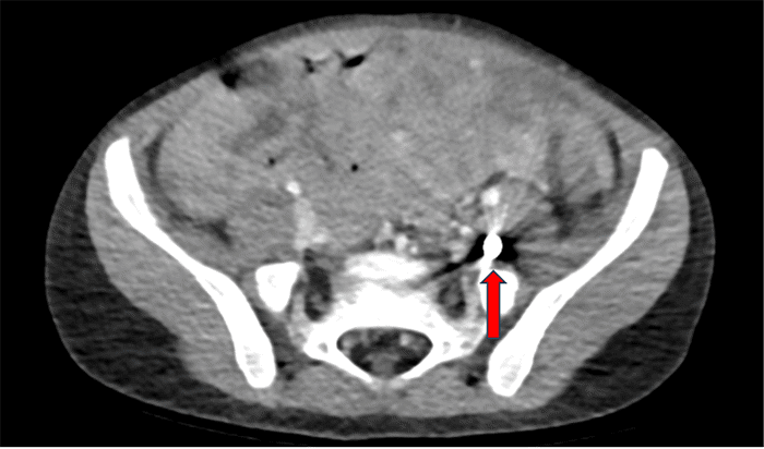 (A) Axial view view of CT abdomen and pelvis showing the retained 9mm ballistic fragment