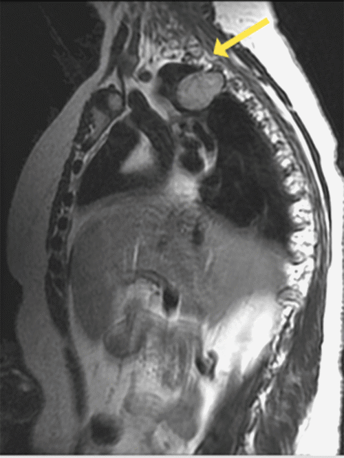 B. Sagittal T2 image shows the mass extending into the right hemithorax (inferior to arrow).