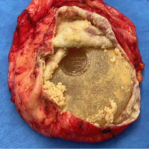 Right capsule was markedly thickened and filled with white caseous material