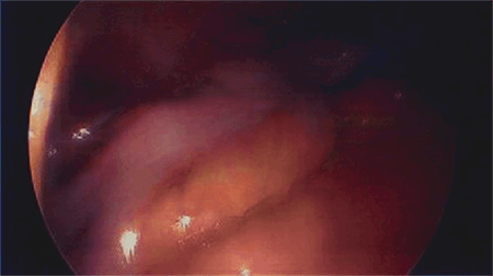 Figure 4. Mesoappendix located in middle of pelvis