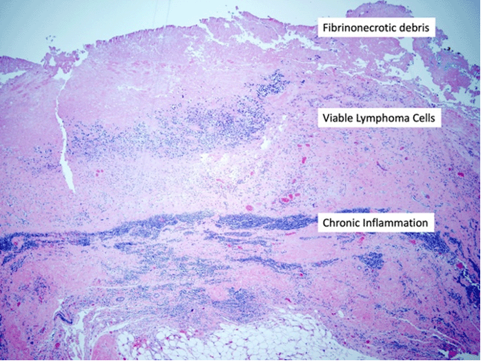 )Low magnification image (4x) showing full-thickness section of right breast implant capsule with abundant fibrinonecrotic debris in luminal aspect with pockets of viable tumor cells and fibroadipose tissue with chronic inflammation in periphery of capsule (hematoxylin and eosin stain)