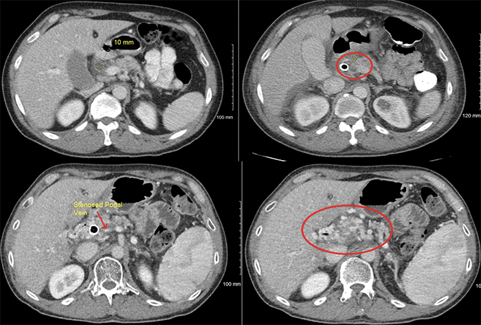 Clockwise: A) CT initial diagnosis showing mass; B) CT showing PV thrombosis; C) CT showing PV stenosis; D) CT peripancreatic varices