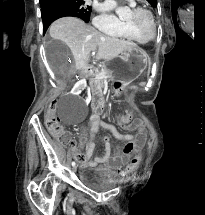Image demonstrates a significantly distended gallbladder with profuse pericholecystic edema, ill-defined hypoenhancing, and thickened wall, wall sloughing, and hemorrhage in keeping with ischemic changes. Thickened soft tissue density at the pedicle suggested gallbladder volvulus (arrows)