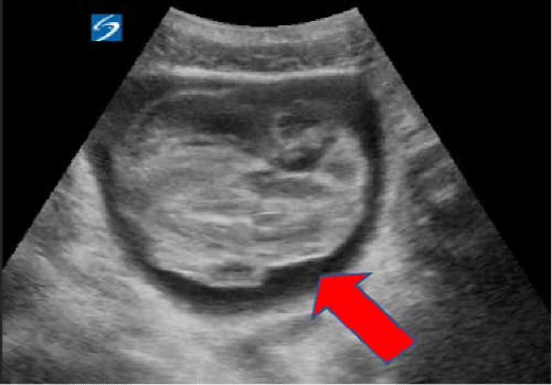 A) Significant clot burden within the bladder