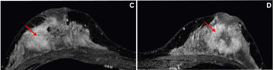 C) MRI, axial view of the right breast with 5.2 × 4.9 × 2.6 cm irregular mass with involvement of nipple base to pectoralis fascia with notable nipple retraction. D) MRI, axial view of the left breast with 3.8 × 4.2 × 3.0 cm irregular mass with involvement of the nipple base to pectoralis fascia with notable nipple retraction.
