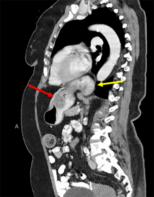 Note evidence of tumor growth on anterior wall of the stomach (red arrow); CT also displays sliding hiatal hernia (yellow arrow)
