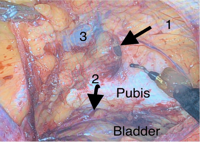 1) femoral hernia; 2) obturator hernia; 3) external iliac vein