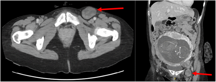 A) Axial and B) coronal view of the CT scan showing the femoral hernia (arrows).
