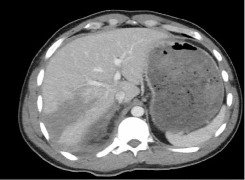 A) Grade IV liver laceration.