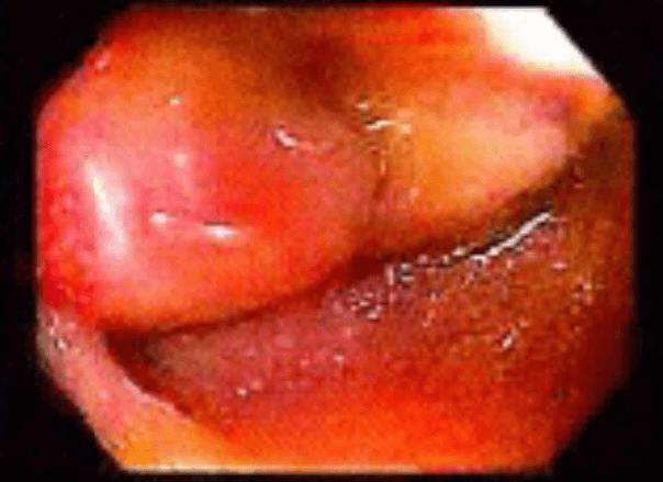 Figure 1. Terminal ileum mass seen on routine colonoscopy