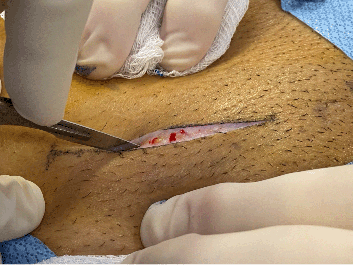 A) Note cut hypodermic vessels and subsequent bleeding