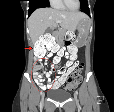 Figure 1. The cecum is abnormally displaced in the right upper quadrant (arrow), with a significant amount of small bowel clustered to the right lower quadrant (circle).