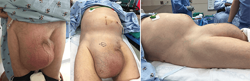 Figure 1. Pre-operative appearance of giant inguinoscrotal hernia