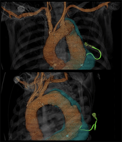 Figure 3. 3-dimensional reconstruction of CTA in coronal and oblique views demonstrating the catheter within the TAAA
