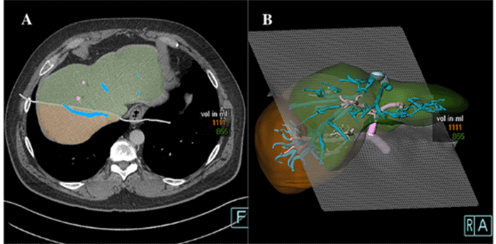 Estimated graft volume of 1111 cc using a plane along the right hepatic vein for transection
