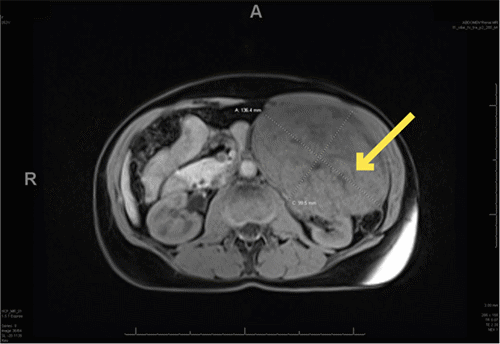 A) Image depicting without intravenous contrast