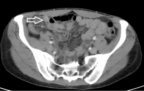 A) Terminal ileum, axial view