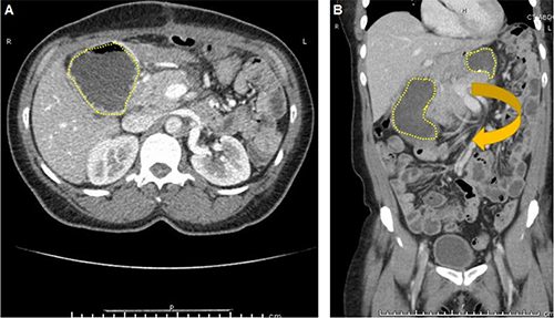 Figure 1. A CT scan of the patient on the day of her presentation to a routine clinic appointment, 13 days after her laparoscopic DPS. A: On transverse sections of the CT scan, the stomach is seen to be abnormally present on the right side of the abdomen (yellow-dashed line). B: On coronal sections of the CT scan, the stomach is imaged with both the cranial portion visible to the left of midline and the caudal portion visible to the right of the midline (both outlined in yellow dashes) with an arrow denoting the direction of volvulus.