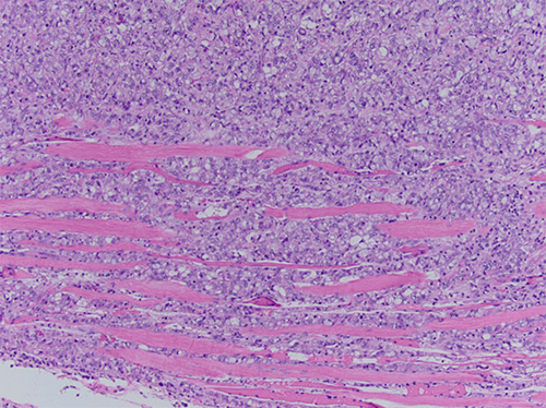 Signet Ring Cell Carcinoma of the Breast: An Aggressive Tumor | ACS