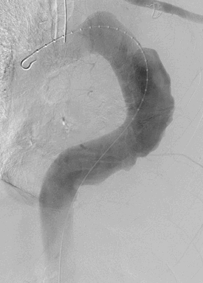Figure 4: intraoperative aortogram demonstrating aneurysmal degeneration of the thoracic aorta without evidence of rupture