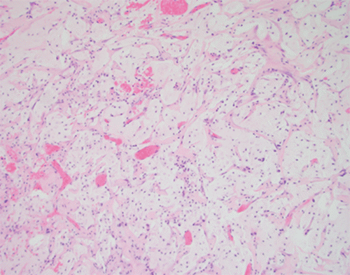 H&E stain (10x original magnification) illustrating characteristic dissecting pools of extracellular mucin within the pancreatic parenchyma. These mucin pools are associated with the mucinous neoplasm and are a hallmark feature