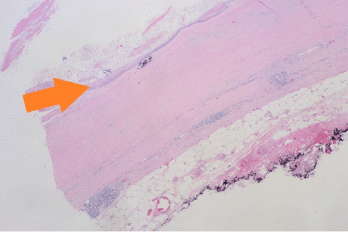 Note A) squamous lining of the cyst (orange arrow)