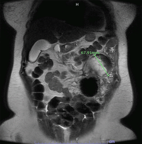 A left upper abdominal mass measuring 6.8 × 5.6 × 6.8 cm is observed to originate from a proximal jejunal loop in close proximity to the gastrojejunostomy anastomosis. The lesion displays ill-defined central enhancement near its attachment to the small bowel, surrounded by T2 hyperintense cystic contents and a peripheral T2 hypointense rim. Panels A and B depict horizontal and coronal views, respectively