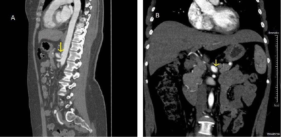 A) Note median compression ligament compression of celiac artery (arrow); and B) celiac artery dissection (arrow)
