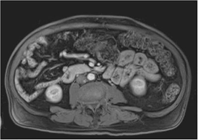 Figure 2: Preoperative imaging showing C-loop of the duodenum not traversing the midline posterior to the superior mesenteric vessels leaving the small bowel on the right side of the abdomen.