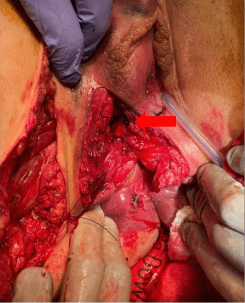 Intraoperative photograph showing the primary repair of the anterior rectal wall defect (arrow) down to the level of the disrupted anal canal, prior to sphincteroplasty