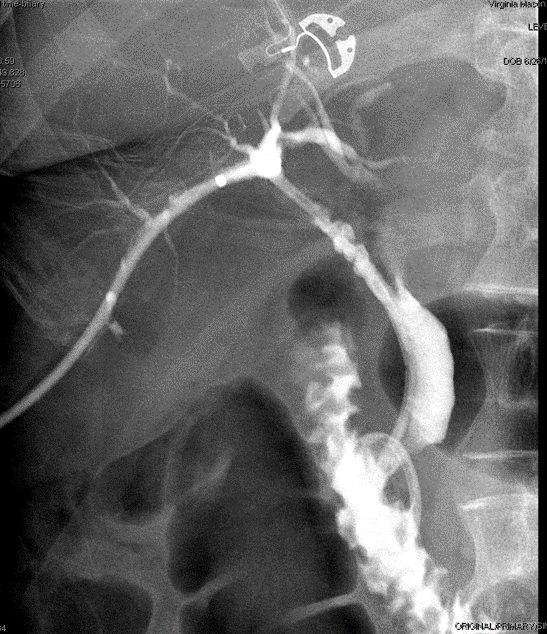 Figure 7. Final rendezvous cholangiogram showing flow through PTBD through the previous biloma cavity, cystic duct and CBD, finally into the duodenum. 