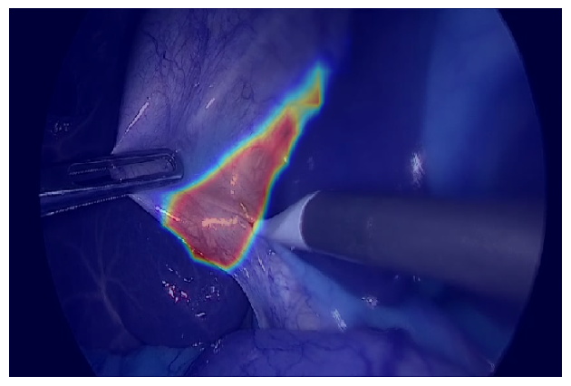 Figure 2: Examples of a convolutional neural network that is capable of providing real-time predictions during a laparoscopic cholecystectomy for the GO zone (safe area to dissect) and NO-GO zone (dangerous area to dissect in with a high likelihood of major bile duct injury). 