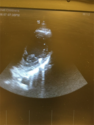 Figure 2. Cardiac window showing foreign body inside the heart with no pericardial effusion.