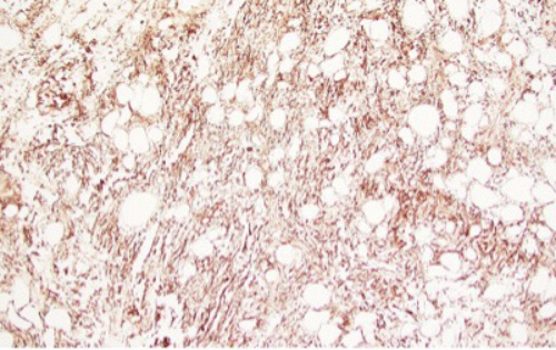 mmunohistochemical stain for CD34 (100x magnification) demonstrating diffuse positive staining within the spindled stromal cell component and capillary endothelium