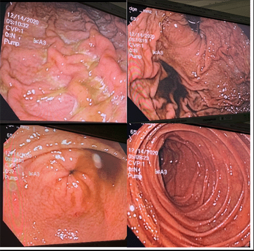 Composite of intraoperative endoscopic images. (Top left and top right) Views of the gastric body and fundus showing areas of purulent exudate and mucosal cobblestoning, consistent with severe gastritis. Despite these changes, the underlying gastric mucosa appears viable and perfused. (Bottom left) Endoscopic view of a patent pylorus. (Bottom right) Endoscopic view of the proximal duodenum, appearing normal and well-perfused. No evidence of frank ulceration, necrosis, or perforation was identified