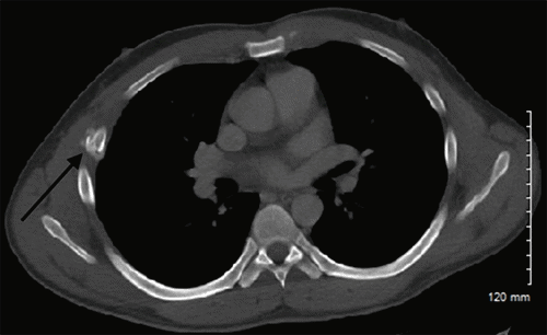 Gallbladder Rupture Lung Delayed Presentation of Isolated Traumatic Gallbladder Rupture with ...