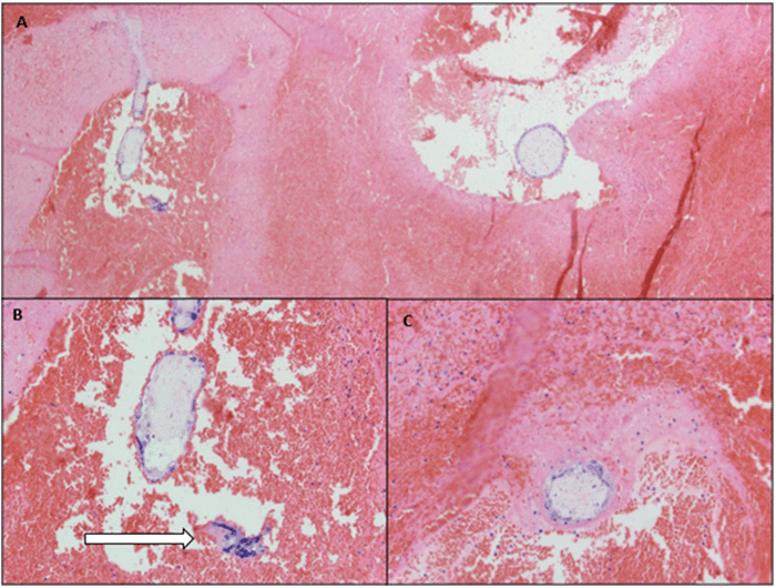 (A) Chorionic villi within hemorrhagic debris of the fallopian tube, diagnostic of ectopic tubal pregnancy (H&E, original magnification x4); (B) chorionic villus and syncytiotrophoblast (arrow) (H&E, original magnification x20); and (C) chorionic villus within hemorrhagic debris (H&E, original magnification x20).