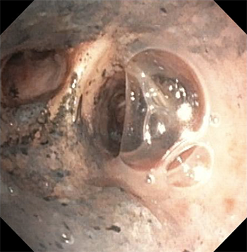 Figure 1. Repeat bronchoscopy the day following admission reveals carbonaceous deposits at the carina. 