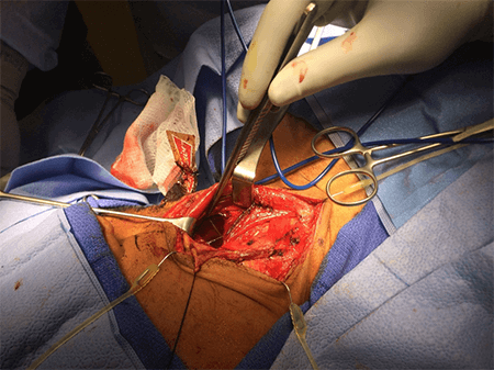 Figure 4. Collar incision exploration of the left lateral neck exposing the anatomy in relation to the foreign body.