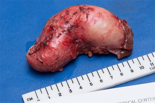 Figure 3: Patient’s distended gallbladder after removal measuring 12.5 x 5.5 x 5.0 cm