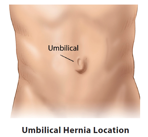 Adult Umbilical Hernia Repair