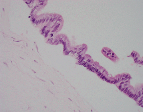 H&E stain (40x original magnification) providing a higher-power view of the low-grade mucinous carcinoma cells. The atypical epithelial cells are seen infiltrating within a prominent, dense desmoplastic stroma