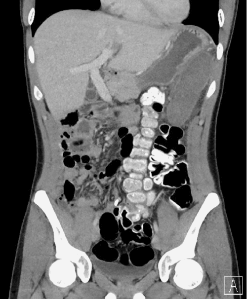 Colon on left, small bowel on right due to congenital malrotation