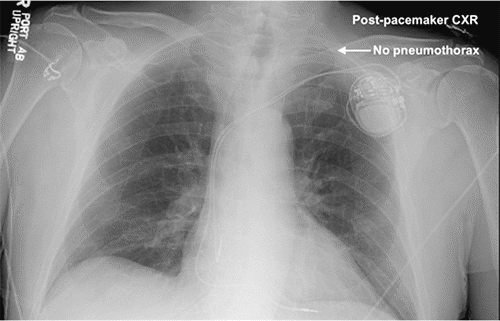 Image depicting placement of dual-chamber permanent pacemaker via left subclavian vein.