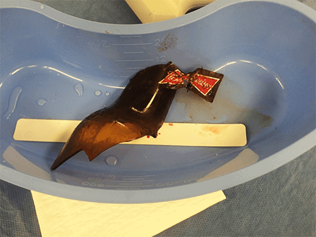 Figure 5. Foreign body pathology specimen.