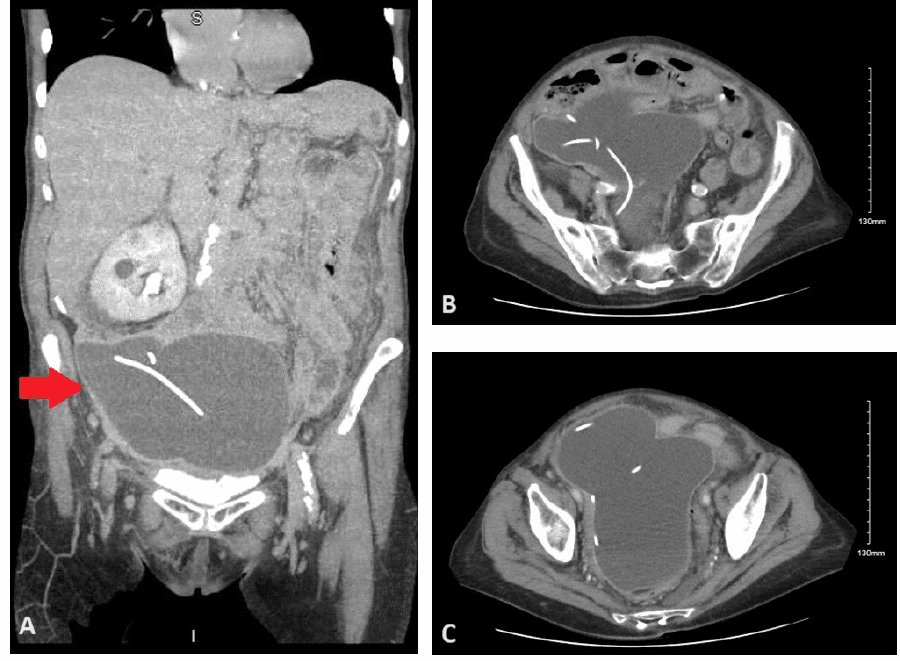 (A) Coronal view highlighting the extensive nature of the pseudocyst (red arrow). (B, C) Axial views showing the large APC containing the distal VP shunt catheter tip and demonstrating significant mass effect